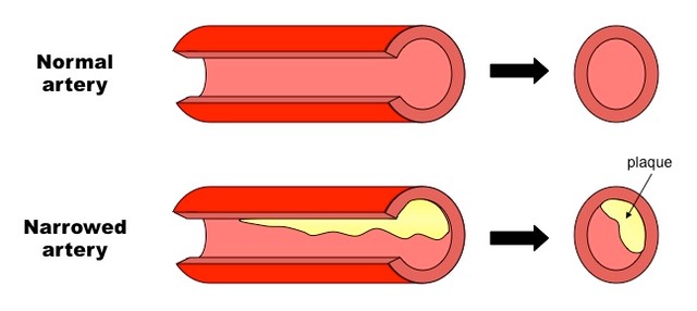 atherosclerosis