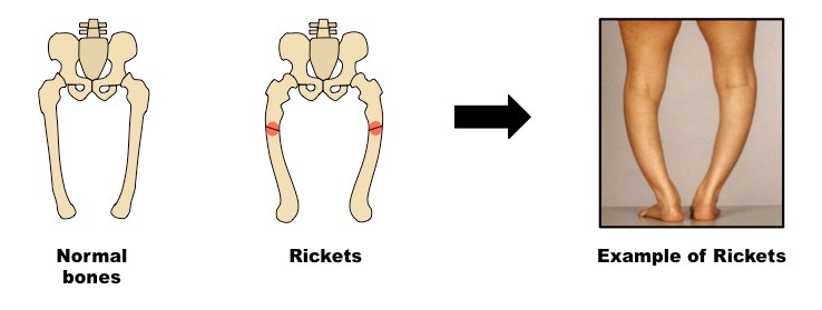 rickets