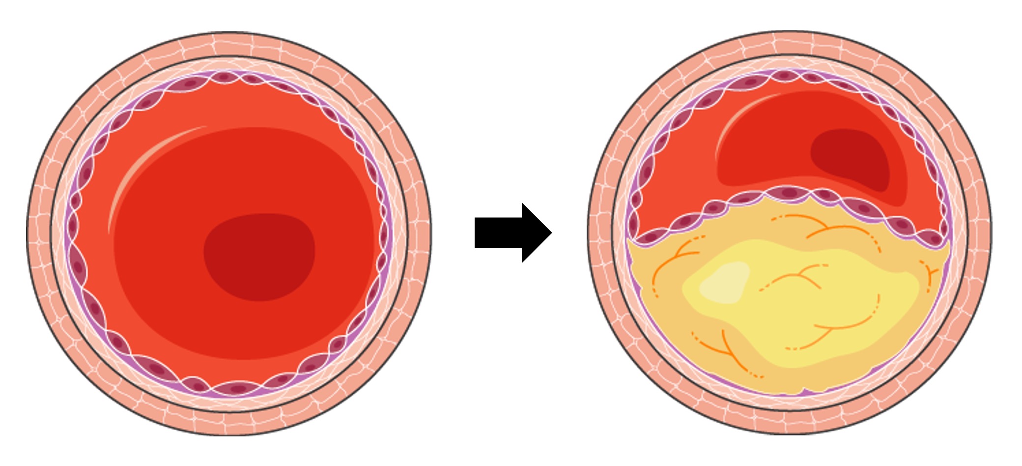 atherosclerosis%20mobile